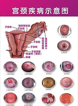 宫颈口裂开图片图片